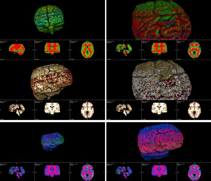 3D Workflow for Segmentation and Interactive Visualization in Brain MR images using Multiphase Active Contours