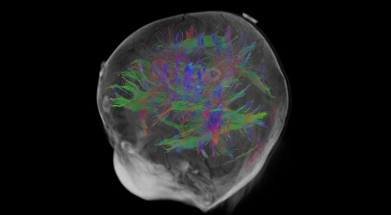 Olea Sphere® post-processing 3D software suite for vascular and oncology imaging