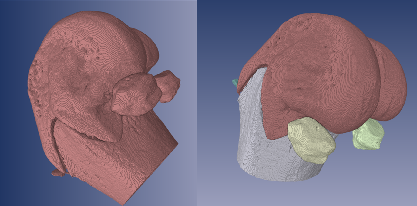 AccuCT™ software for bone analysis