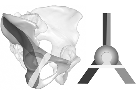 Secure corridor for infraacetabular screws in acetabular fracture fixation—a 3-D radiomorphometric analysis of 124 pelvic CT datasets