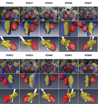 Patient-specific anatomical model for deep brain stimulation based on 7 Tesla MRI