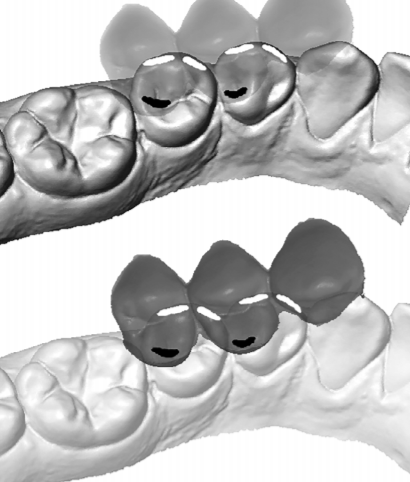 Variation of 3D outer and inner crown morphology in modern human mandibular premolars