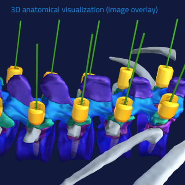 ARAI™ : Advanced surgical navigation guidance platform (HOLOSURGICAL)