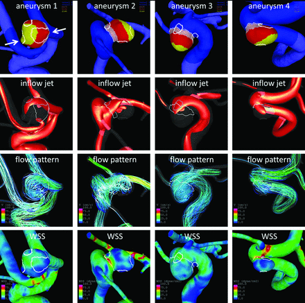 Regional Aneurysm Wall Enhancement is Affected by Local Hemodynamics: A 7T MRI Study