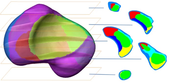 3D computational anatomy of the scaphoid and its waist for use in fracture treatment